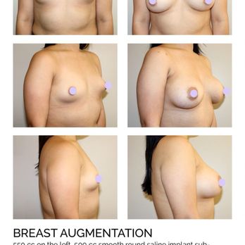 Zarrabi Plastic Surgery - Breast Augmentation - Cosmetic Surgeons Near Me - Beverly Hills, California Zarrabi Plastic Surgery - Breast Augmentation - Cosmetic Surgeons Near Me - Beverly Hills, California