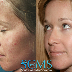 South Coast MedSpa - Ask us about Forever Young BBL!  No downtime.  Quick Healing process.