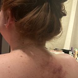 Ez Relaxation - Bruise forming that I got from massage