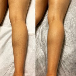 Iconic Esthetics - Full leg wax using hard wax by our experienced waxer Cindy