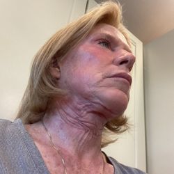 Robert Cristel, MD: Synergi Facial Surgery - After