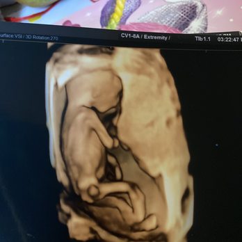 3D-4D Ultrasound Studio Queens - 14 week ultrasound to find out gender - Diagnostic Imaging Near Me - Flushing, New York