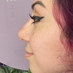 SKIN By Miss M - Non-surgical nose correction with Hyaluronic pen