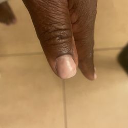 Hollywood Institute - Lumpy, spotty and discolored gel nail color