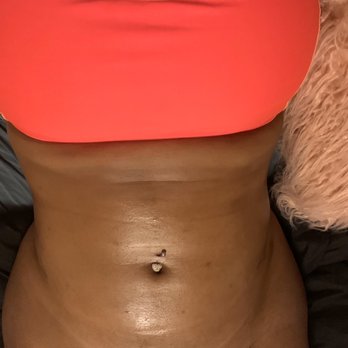 The Best U Now Plastic Surgery - 6 months post 360 lipo (looks the same pre-surgery) - Medical Spas Near Me - Plantation, Florida