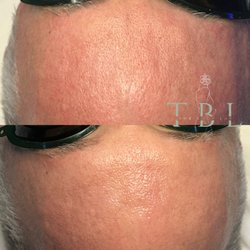 Large pore before. Less visible pores and smooth hydrated skin
