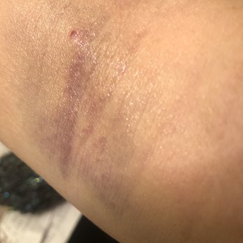 Octapharma Plasma - Aurora - I need a mark of how far the person push the needle into my arm to collapse my vein. Beware! - Blood & Plasma Donation Centers Near Me - Aurora, Illinois Octapharma Plasma - Aurora - I need a mark of how far the person push the needle into my arm to collapse my vein. Beware! - Blood & Plasma Donation Centers Near Me - Aurora, Illinois