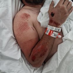 Piedmont Athens Regional Sleep Disorders Center - The open wounds I left the hospital with and the complete disregard of placement of wristbands over open wounds