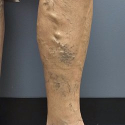 Siragusa Vein and Laser - Our patient wanted to stop her legs from hurting and swelling, and also get rid of these bulging varicose vceins.