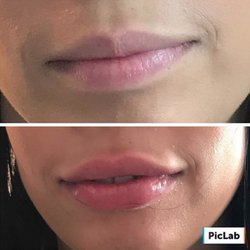 Dolce Aesthetics - Botox, Lip injection, Juvederm, Jaw Cheek Contouring, Non surgical nose jobs, Laser facials, Kybella, Voluma, Microneedling, Chemical peel