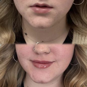 dermani MEDSPA® Mansfield - Lip filler - Medical Spas Near Me - Mansfield, Texas