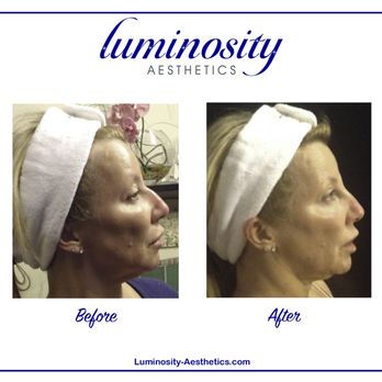 Luminosity Aesthetics - Liquid Rhinoplasty. - Skin Care Near Me - Asheville, North Carolina Luminosity Aesthetics - Liquid Rhinoplasty. - Skin Care Near Me - Asheville, North Carolina
