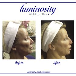 Luminosity Aesthetics - Liquid Rhinoplasty.