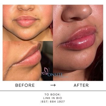 Onsite Wellness Now - Lip filler, client received 1 syringe of RHA 2 - Medical Spas Near Me - Orange, California