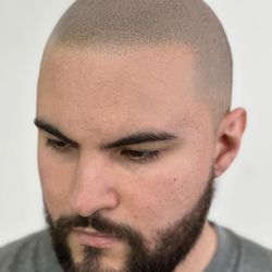 Picasso Scalp Micropigmentation