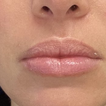 Plump Cosmetics & Injectables - After - Dermatologists Near Me - New York, New York