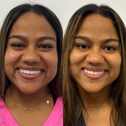 Lifted Aesthetics Charlotte - Eye opening injections Botox Dysport Xeomin Letybo