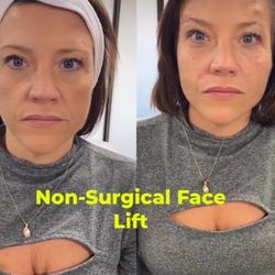 New Journey Medical & Aesthetics - Experience the dramatic change with this non-invasive facelift option. Book today to lift and transform your skin!