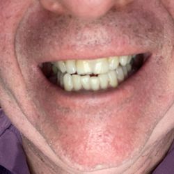 Pennsylvania Dental Group - A chip was repaired on one of my tip fronts. I am very happy w the work!