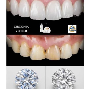 Paul C. Chang - Veneers that can last a lifetime!! Diamonds are forever! - General Dentistry Near Me - Upland, California Paul C. Chang - Veneers that can last a lifetime!! Diamonds are forever! - General Dentistry Near Me - Upland, California