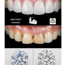 Paul C. Chang - Veneers that can last a lifetime!! Diamonds are forever!