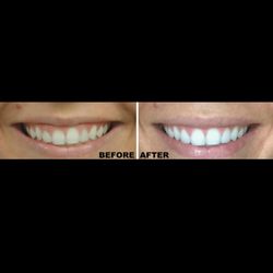 Buttermilk Family and Cosmetic Dentistry - Laser Gum Contouring & New Veneers (BEFORE & AFTER)