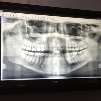 OC Oral Surgery - My X-ray before wisdom teeth removal. - Oral Surgeons Near Me - Aliso Viejo, California OC Oral Surgery - My X-ray before wisdom teeth removal. - Oral Surgeons Near Me - Aliso Viejo, California