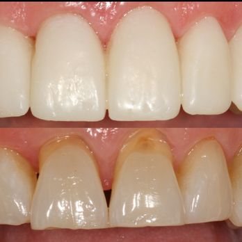 VIKARA - These were only the temporary veneers. - Orthodontists Near Me - Miami, Florida