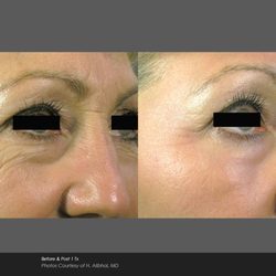 Medical Weight Management - Our Icon1540 Fractional laser can give 70 percent clearance on wrinkles, surgical scars and stretch marks .