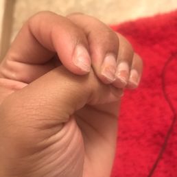 After result of having to get theses thick ass nails removed After result of having to get theses thick ass nails removed