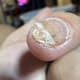 Major chemical burn and uv light burn. Nails separating from nails bed. Major fungal infection due to uncleanliness. Major chemical burn and uv light burn. Nails separating from nails bed. Major fungal infection due to uncleanliness.