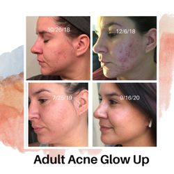 Acne treatments and home routines are so worth it