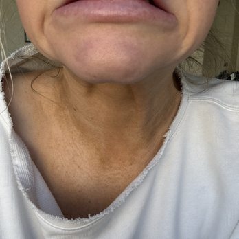 NakedMD - Temecula - If daos were injected I wouldn't be able to make this face. The incorrect injection of the Botox has left me with extreme jowl and dimples. - Medical Spas Near Me - Temecula, California