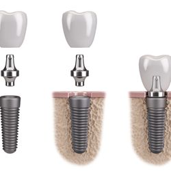 AZ Periodontics and Implant Dentistry - Free implant consultations when you mention yelp.
