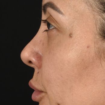 Oneline Beauty Clinic - Now I have these jowl looking bags on the side of my face which they refuse to remove unless I pay - Skin Care Near Me - Cancún, ROO
