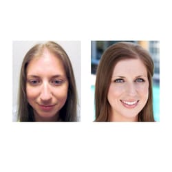 Bosley Hair Restoration & Transplant