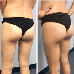 Curve Design - Non invasive "instant" butt lift
