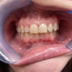 The Modern Orthodontist - This is what 7,500 dollars got me and years of f pin afterwards