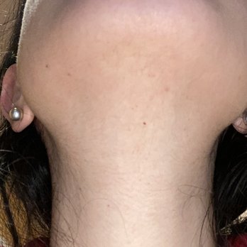 Boston Skin Solutions - After Bridget - Hair Removal Near Me - Brookline, Massachusetts