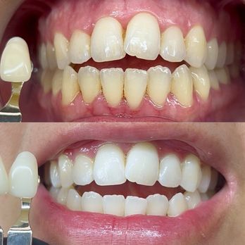 The Coco Blanc Teeth Whitening - Visit one and visit two side by side - Teeth Whitening Near Me - Whittier, California The Coco Blanc Teeth Whitening - Visit one and visit two side by side - Teeth Whitening Near Me - Whittier, California