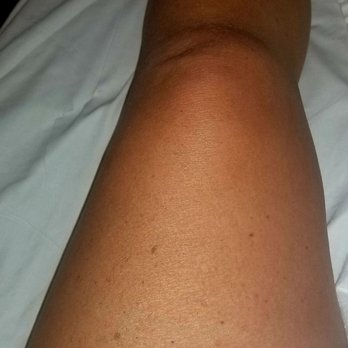 Onvida Health - Left leg with blood clots, 8 inches bigger than the right!! - Hospitals Near Me - Yuma, Arizona Onvida Health - Left leg with blood clots, 8 inches bigger than the right!! - Hospitals Near Me - Yuma, Arizona
