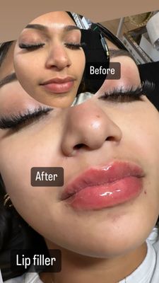 Lip Fillers - Love your smile even more!
Enhance volume, shape, and symmetry with safe, subtle lip fillers performed by our experienced professionals.