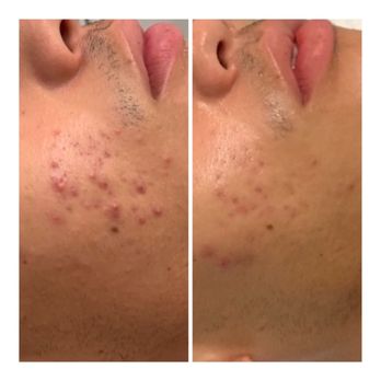 Thrēo Skin - This was just after 2 and a half weeks of treatment! - Skin Care Near Me