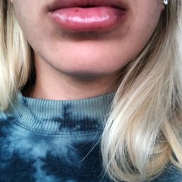 This was a few hours after my appointment. A little swollen, but almost no bruising. This was a few hours after my appointment. A little swollen, but almost no bruising.