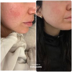 A+ Day Spa - Before and after 3rd CO2 session with Coco
