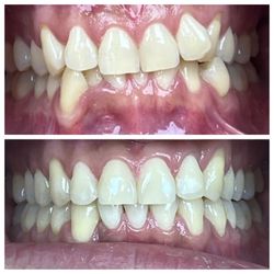 Family Smile Dental - Minor tooth correction, huge difference-Invisalign