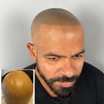 Smp Masters - SMP Correction & Repair - Previous pigment adjusted and refined to achieve proper density, hairline balance, and a more realistic result. - Hair Loss Centers Near Me - Merrick,, New York Smp Masters - SMP Correction & Repair - Previous pigment adjusted and refined to achieve proper density, hairline balance, and a more realistic result. - Hair Loss Centers Near Me - Merrick,, New York