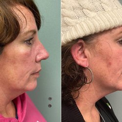 Rhinoplasty Newport Beach, CA