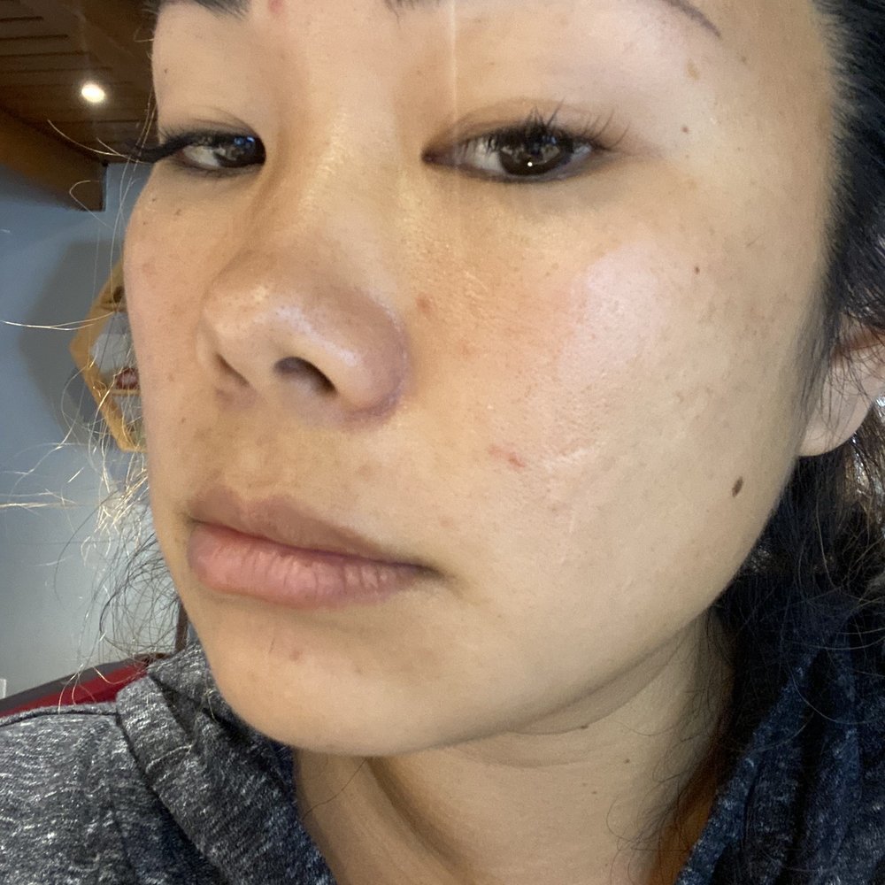 Laser Sculpture - After - Laser Hair Removal Near Me - Tarzana, California Laser Sculpture - After - Laser Hair Removal Near Me - Tarzana, California