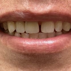 Family Dental of Palatine - Anterior implant